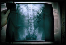 An x-ray showing the lodgement of bird shot pellets in a protestor. Manama, Bahrain, 2013.